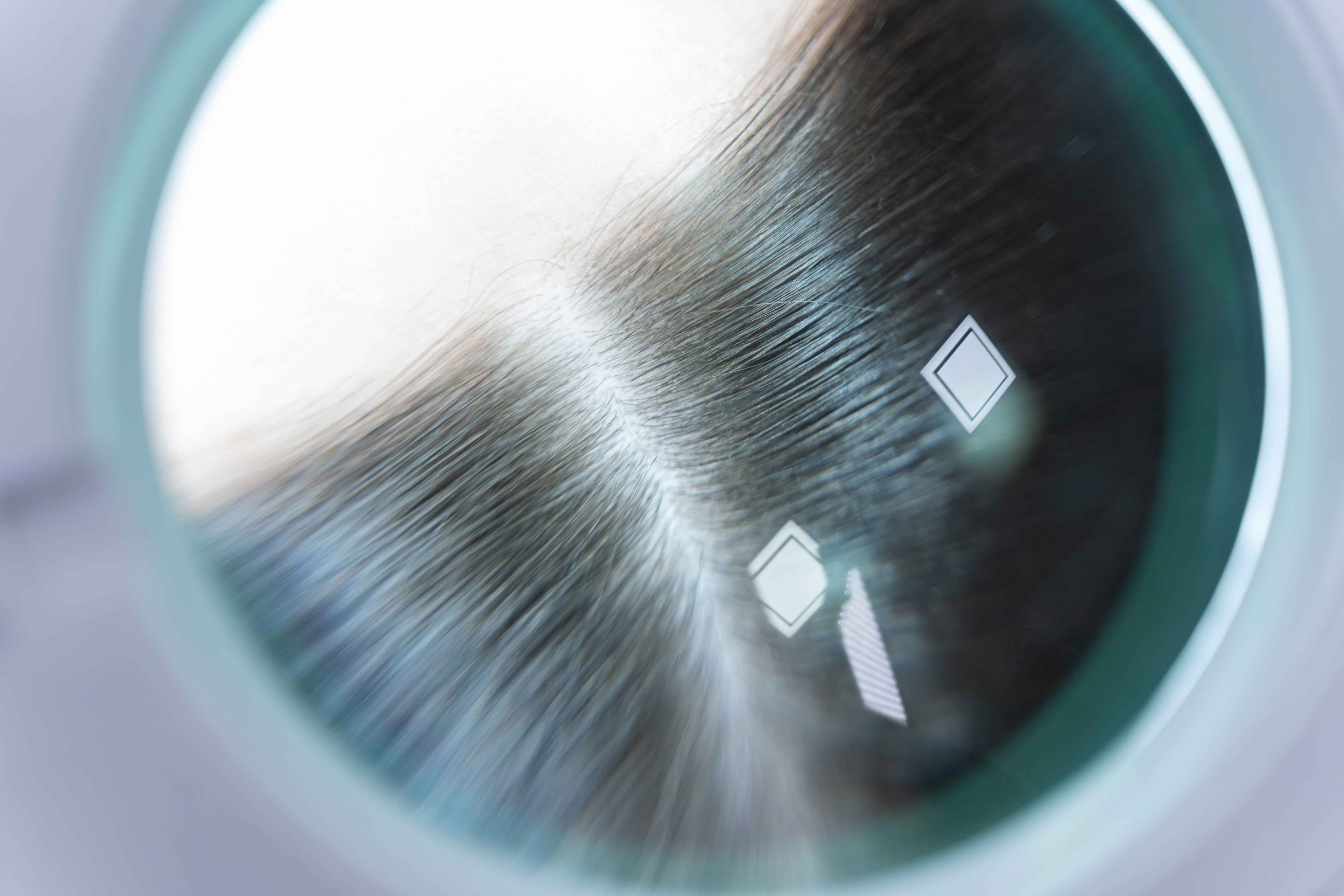 Anti Dandruff Study - Clinical Trial