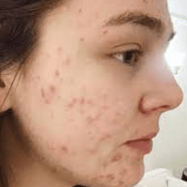 Anti acne