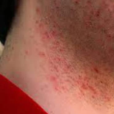 Shaving irritations