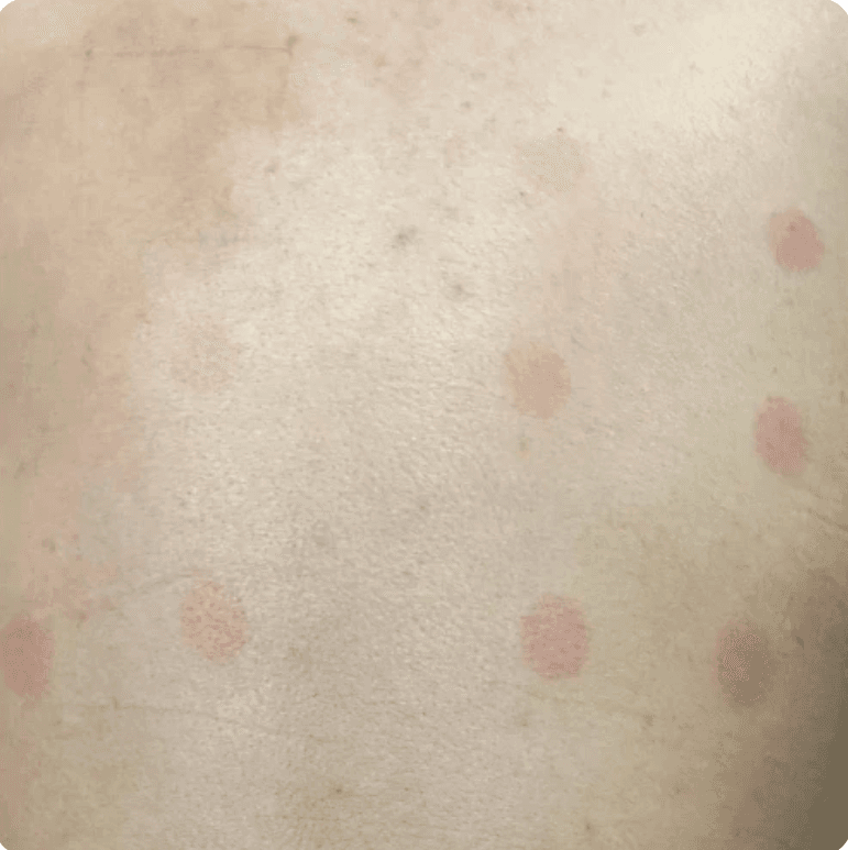 Sunburn Studies - Anti-Erythema Study